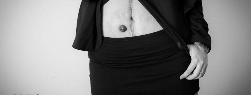 stoma ileostomy femininity black and white photography creative shoot #stomaselfie sam cleasby