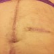 ileostomy j pouch scars post op pictures