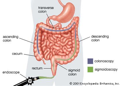 sigmoidoscopy colonoscopy colon 