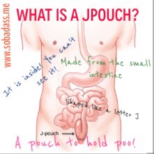 what is a jpouch