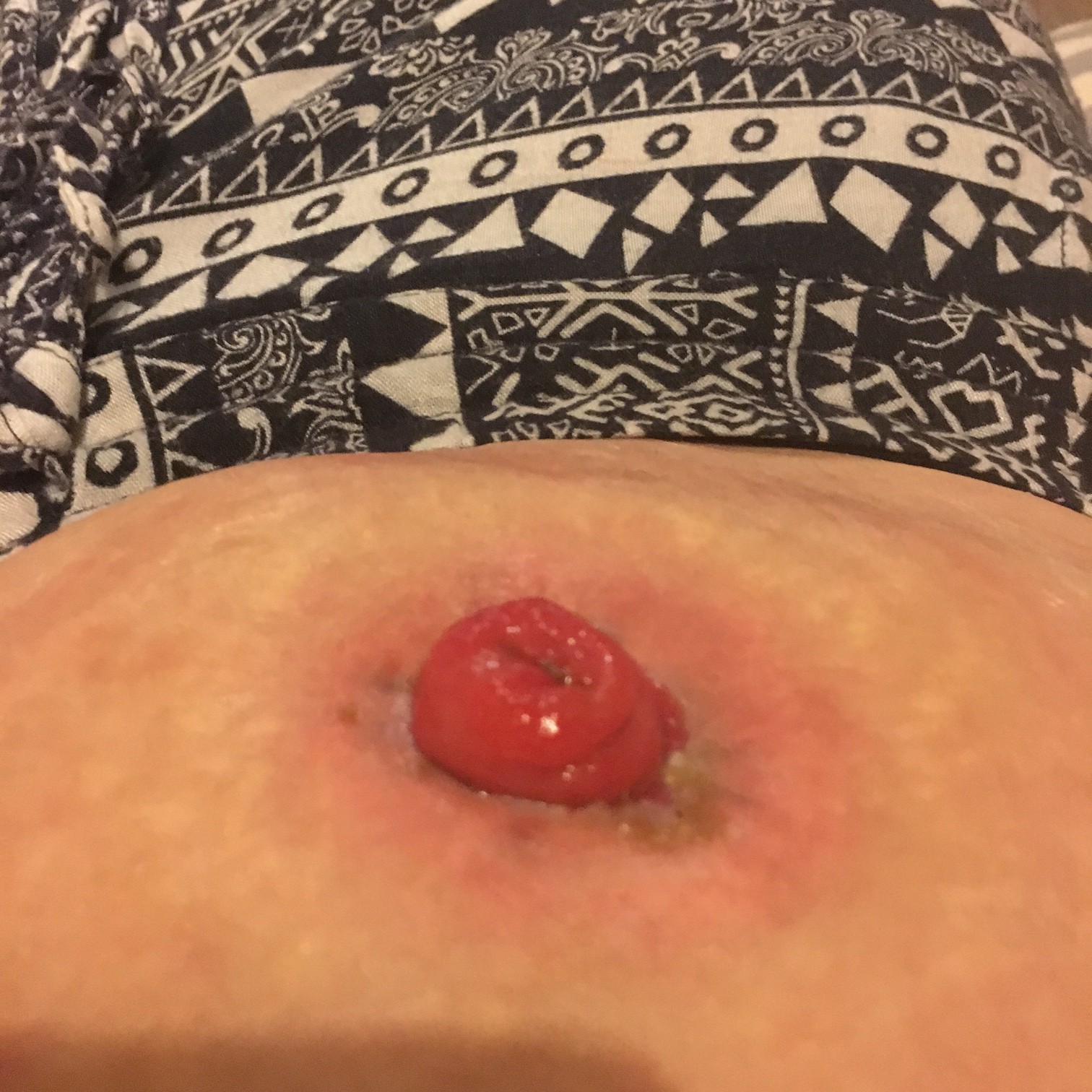 stoma problems my stoma has come away from the skin