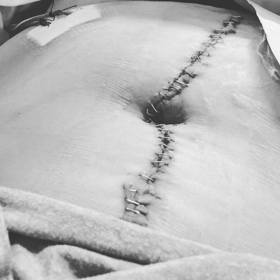 incisional hernia with ostomy surgery staples