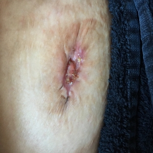 Open stoma wound healing
