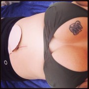 woman ostomy boobs colostomy ileostomy bikini