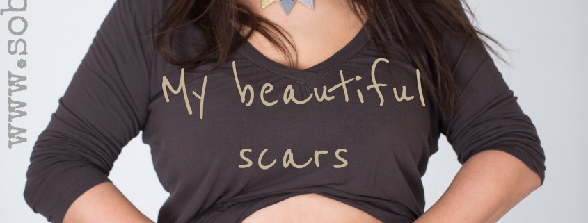 my beautiful scars