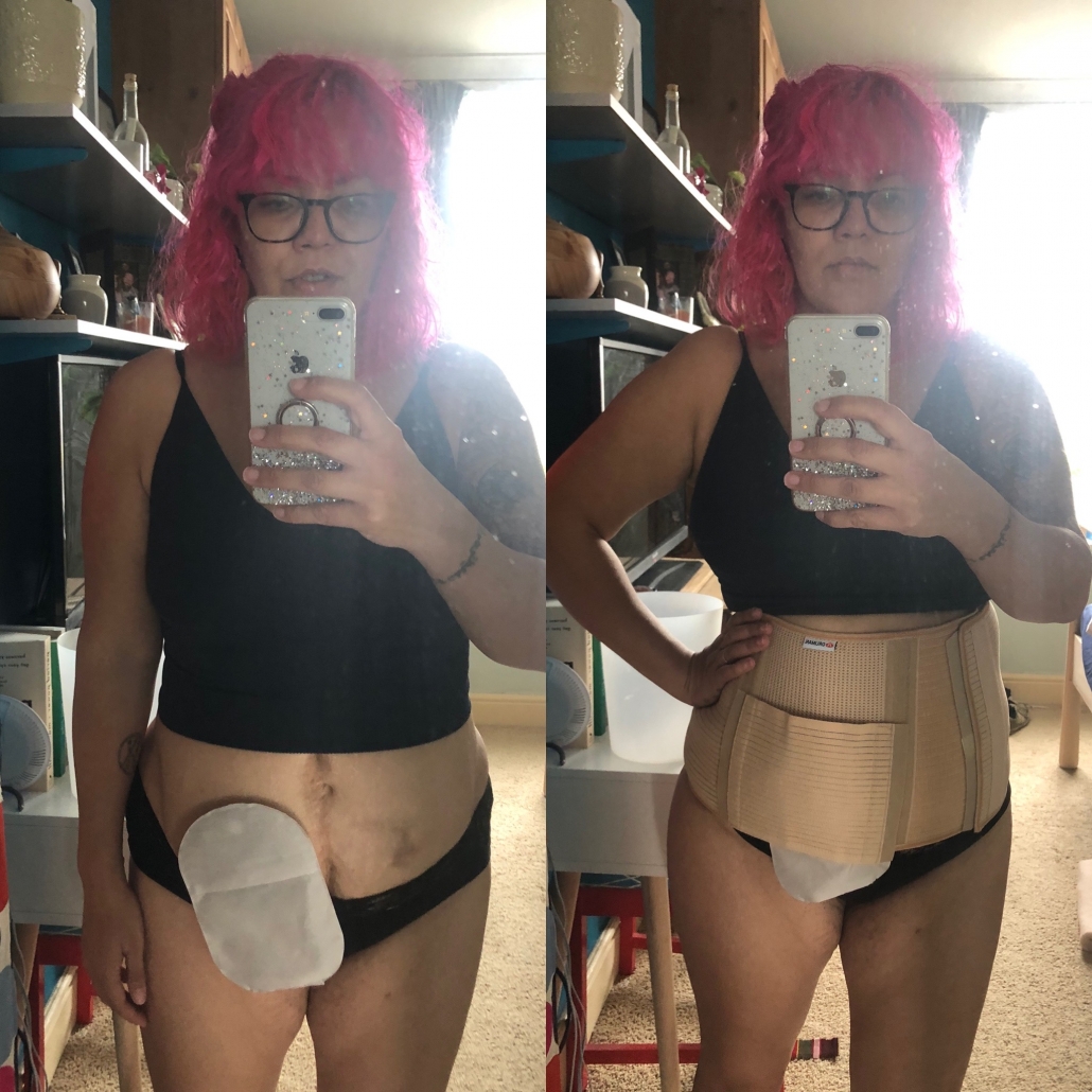Woman with pink hair with hernia and wearing a hernia support belt